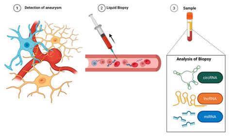 Liquid Biopsy for Cerebral Aneurysms: Circulating RNA as Diagnostic and ...