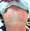 Image result for Peanut Skin Allergy