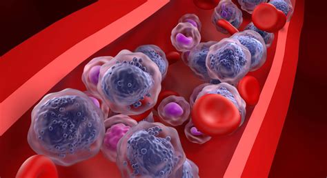 Cáncer de sangre: tipos, síntomas y cómo identificarlo a tiempo