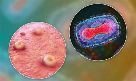 Zelsuvmi Topical Gel Now Available for Molluscum Contagiosum Treatment