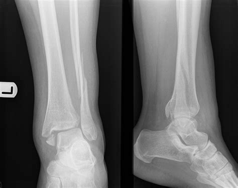 Sprunggelenksfraktur (Typ Weber C) - DocCheck