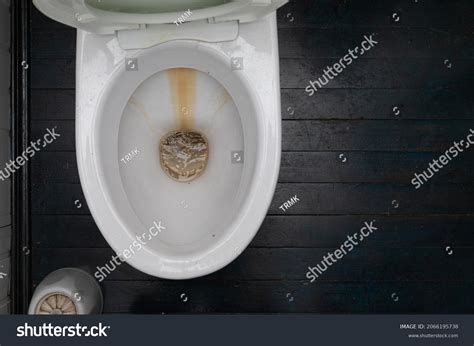 Kidney Stones In The Toilet