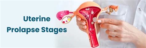 Uterine Prolapse: Stages and Management
