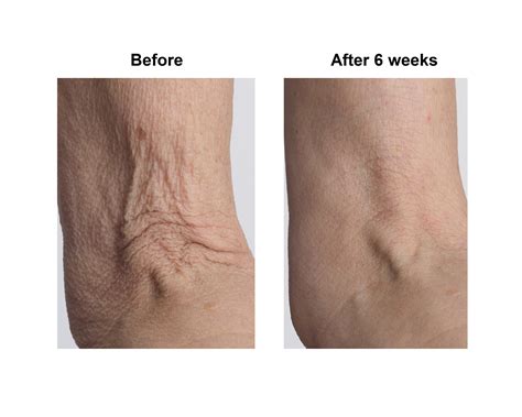 Crepey Skin - 7 Truths Every Woman Must Know