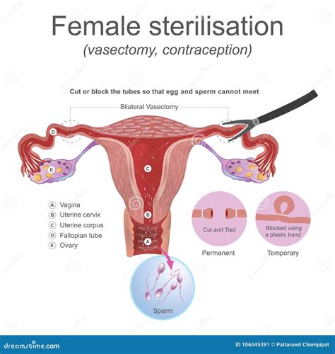 Female Sterilisation Vasectomy. the Male Reproductive System these Work Together To Produce ...