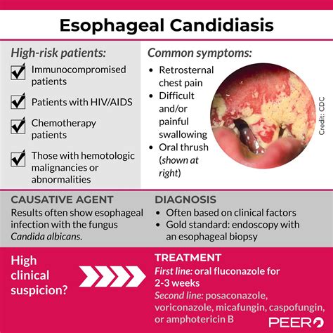 What Is Esophageal Leukoplakia at Phoebe Hercus blog