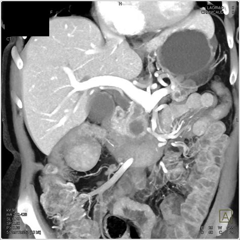 Pancreas Adenocarcinoma with Dilated Pancreatic Duct - Pancreas Radiology Case Studies - CTisus ...