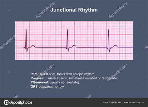 Junctional Tachycardia