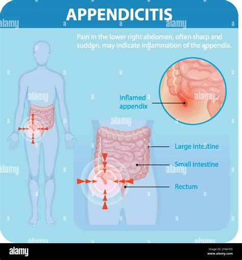 Illustration of appendicitis symptoms and affected areas Stock Vector ...