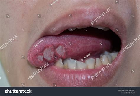 Tongue Ulcer Doctor Near Me at Janelle Mayo blog