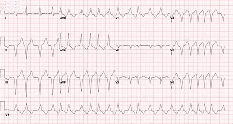 Image result for AFib Detection Algorithm