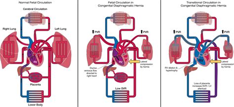 Congenital Diaphragmatic Hernia