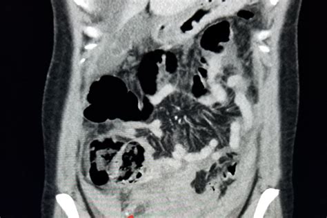 Use of CT scans during pregnancy soars, may pose health risk | Health ...