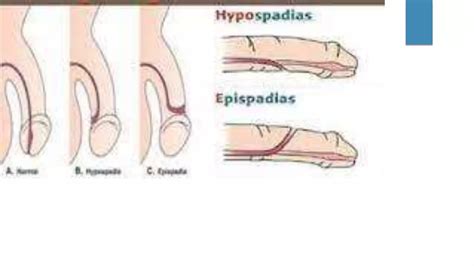 HYPOSPADIAS & EPISPADIAS.pptx