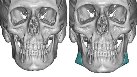 Jaw Angle Implants