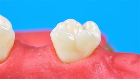 Why Is My Gum Separating From My Back Tooth | GDG