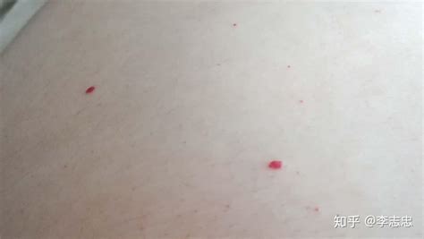 梅毒初期小红疙瘩图片症状，长满硬下疳溃烂(小红点遍布全身) — 神奇养生网