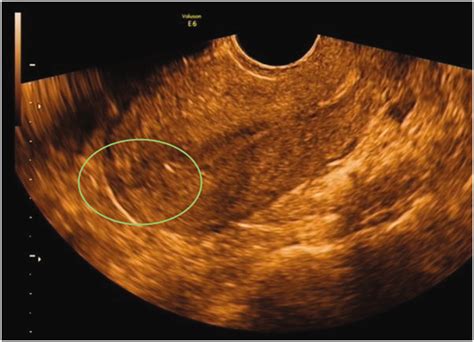 A straw entering the abdominal cavity through the female reproductive tract: a case report ...