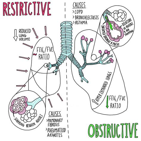 the_littlemedic on Instagram: "Restrictive vs Obstructive Lung Disease ...