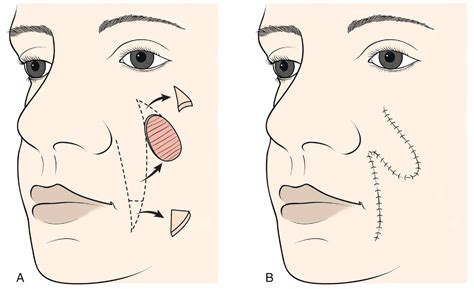 MELOLABIAL FLAPS - Clinical Tree