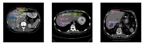 Computer Vision for Tumour 的图像结果