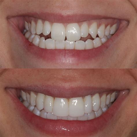 Composite Bonding – Cheshire Dental Centre
