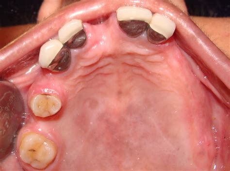 Immediate Replacement of Missing Teeth with Dental Implants - Dr. Ashish Shah