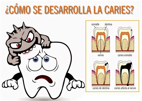Video De Caries Dental at Deidra Mckoy blog