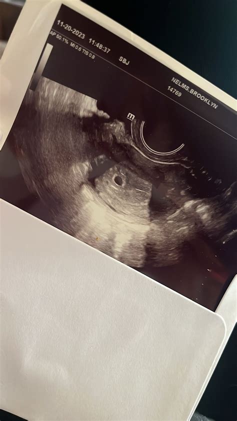 4 weeks ultrasound | BabyCenter