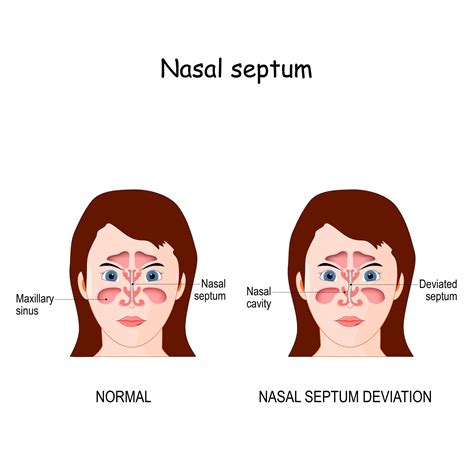 Deviated Septum Diagram How To Manage Deviated Nose: Personal Tips