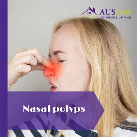 Nasal polyps symptoms and causes – Artofit