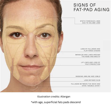 Understanding the Anatomy of Facial Aging Improves Natural Results - Aluma Aesthetic Medicine ...