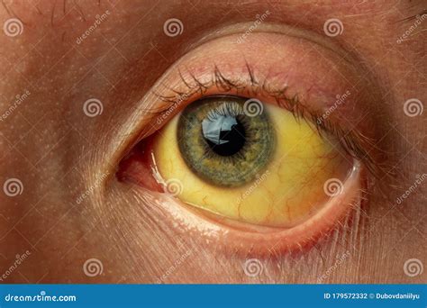 Yellow Staining of the Sclera of the Eye in Diseases of the Liver ...
