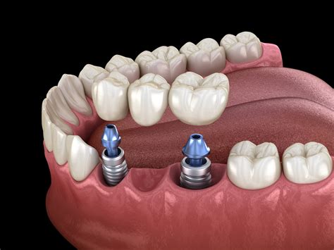 Dental Implant Supported Bridge