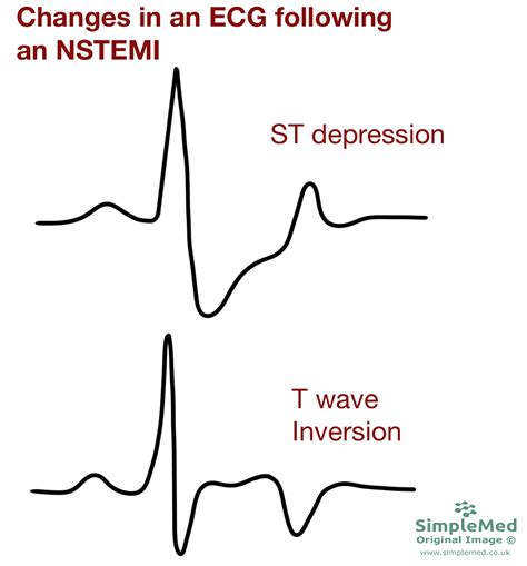 16. Acute Coronary Syndromes - SimpleMed - Learning Medicine, Simplified