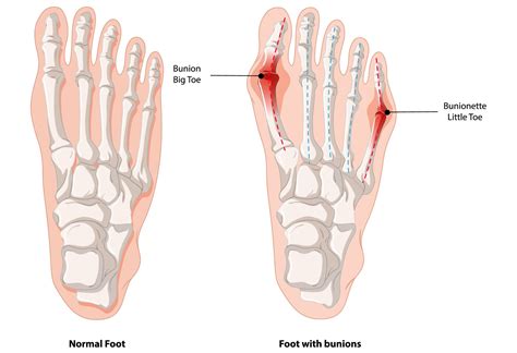 Bunions And Bunionettes