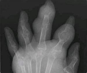 Gout on the Rise: Malaysia's Silent Health Crisis