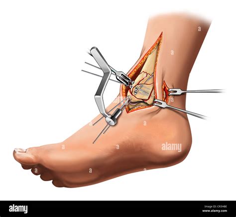 Medial malleolus hi-res stock photography and images - Alamy