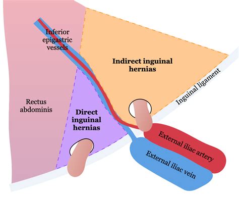 Inferior Epigastric Artery Hernia Inguinal Hernia Diagnosis And