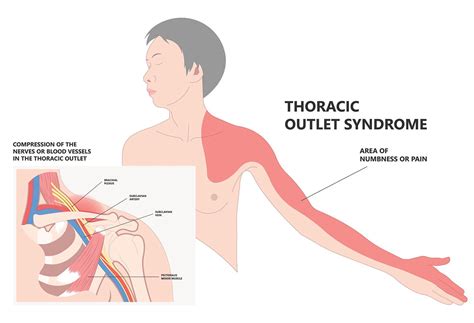 What Is Thoracic Outlet Syndrome