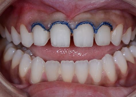 A Cosmetic Dentist Explains the Pros and Cons of Veneers