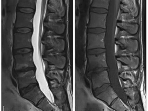Basivertebral Nerve Radiofrequency Ablation (Intracept) | Physicians ...