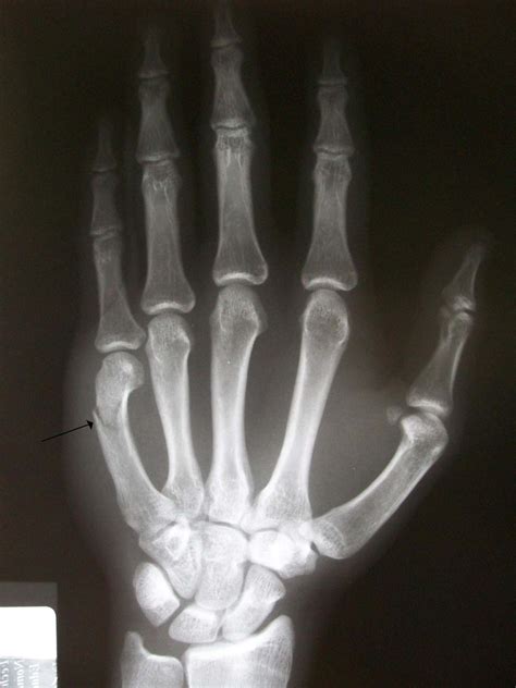 Boxer's Fracture: Fifth Metacarpal Break Symptoms and Treatments