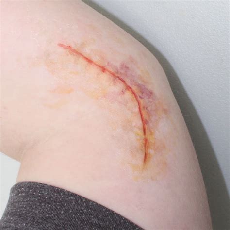 How To Remove Stitches From Gums at Florence Parsons blog