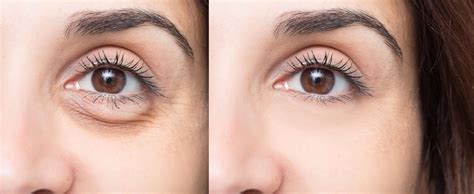 Under-Eye Puffiness: What It Is and How to Treat It – Abera.us