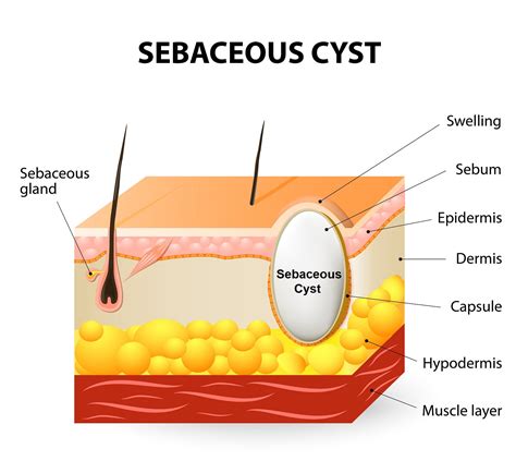 Sebaceous Cyst & Glands 101 for Massage Therapist, Spa & Salon Service ...