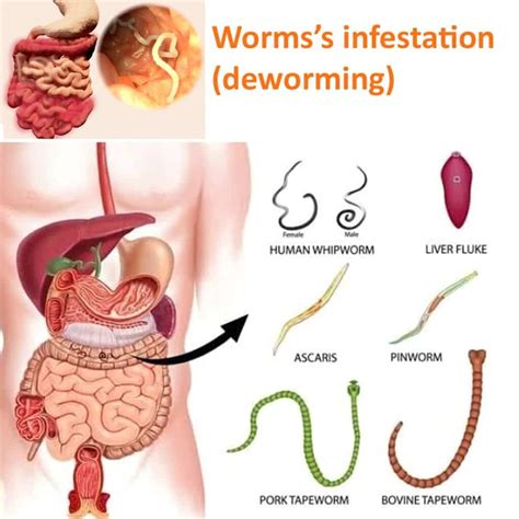 Pinworm Infection In Children – Pinworms In Children – EVWDF