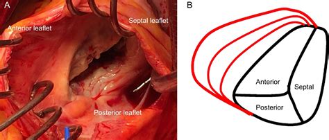 Percutaneous Treatment of the Tricuspid Valve Disease: New Hope for the “Forgotten” Valve ...