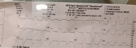 47 YOM, finished gym workout, acute onset crushing substernal chest pain : r/EKGs