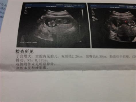 【怀孕36周】怀孕三十六周胎儿图,怀孕36周吃什么、注意什么_亲子百科_太平洋亲子网